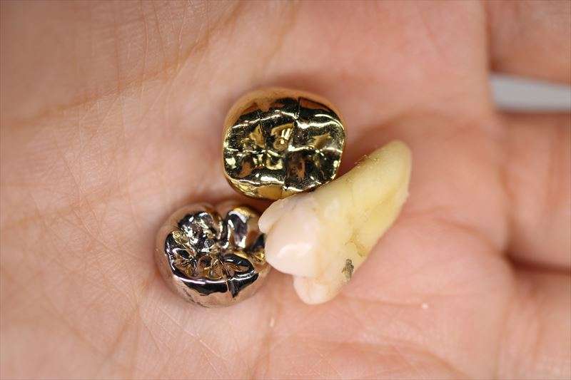 歯の被せ物と詰め物の種類とは