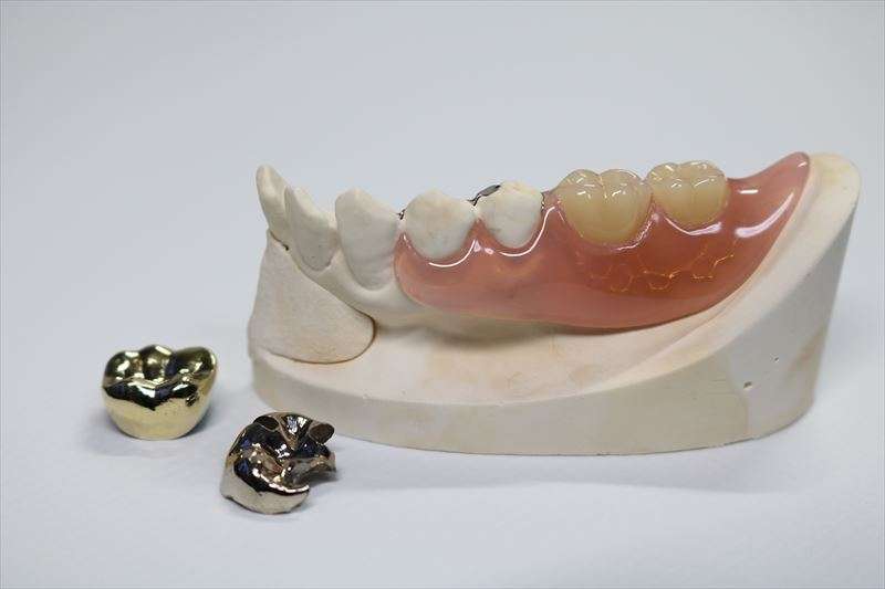 歯科のクラウン(被せ物)の種類は？