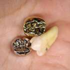 歯の被せ物と詰め物の種類とは