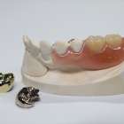 歯科のクラウン(被せ物)の種類は？